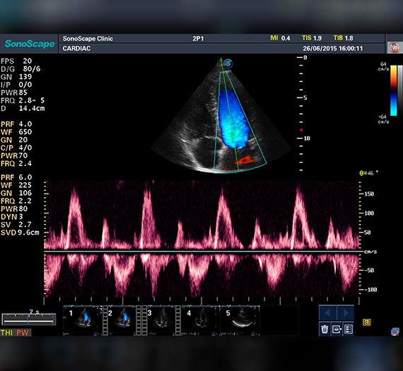 Obraz kliniczny z aparatu USG Sonoscape